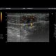 Endometriosis of the abdominal wall: US - Ultrasound